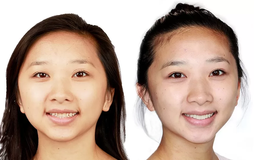 pad_baf TMJ treatment at Franklin Milwaukee Dentist