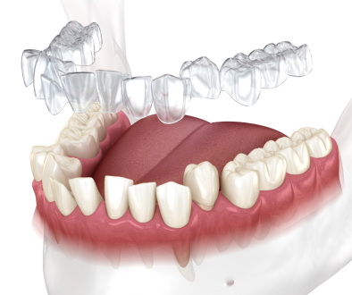 Invisalign® clear aligners by dentist in Franklin Milwaukee