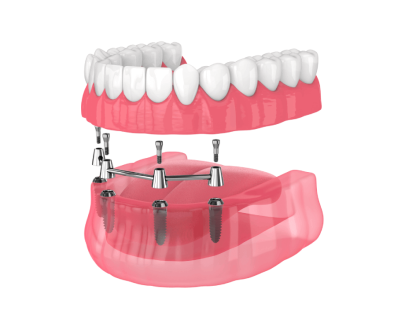 Dentures and Teeth Restoration in Franklin Milwaukee