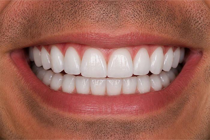 After a smile makeover: an even, bright white smile