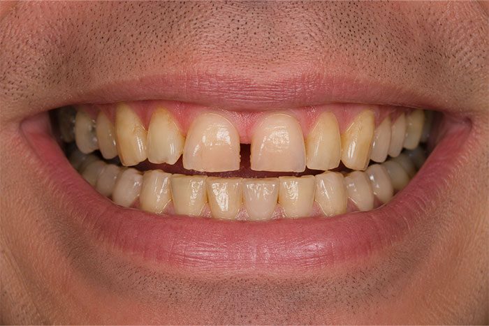 Smile-Makeover-before Cosmetic Dentist Franklin