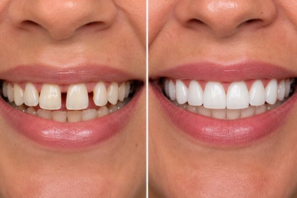 smile makeover